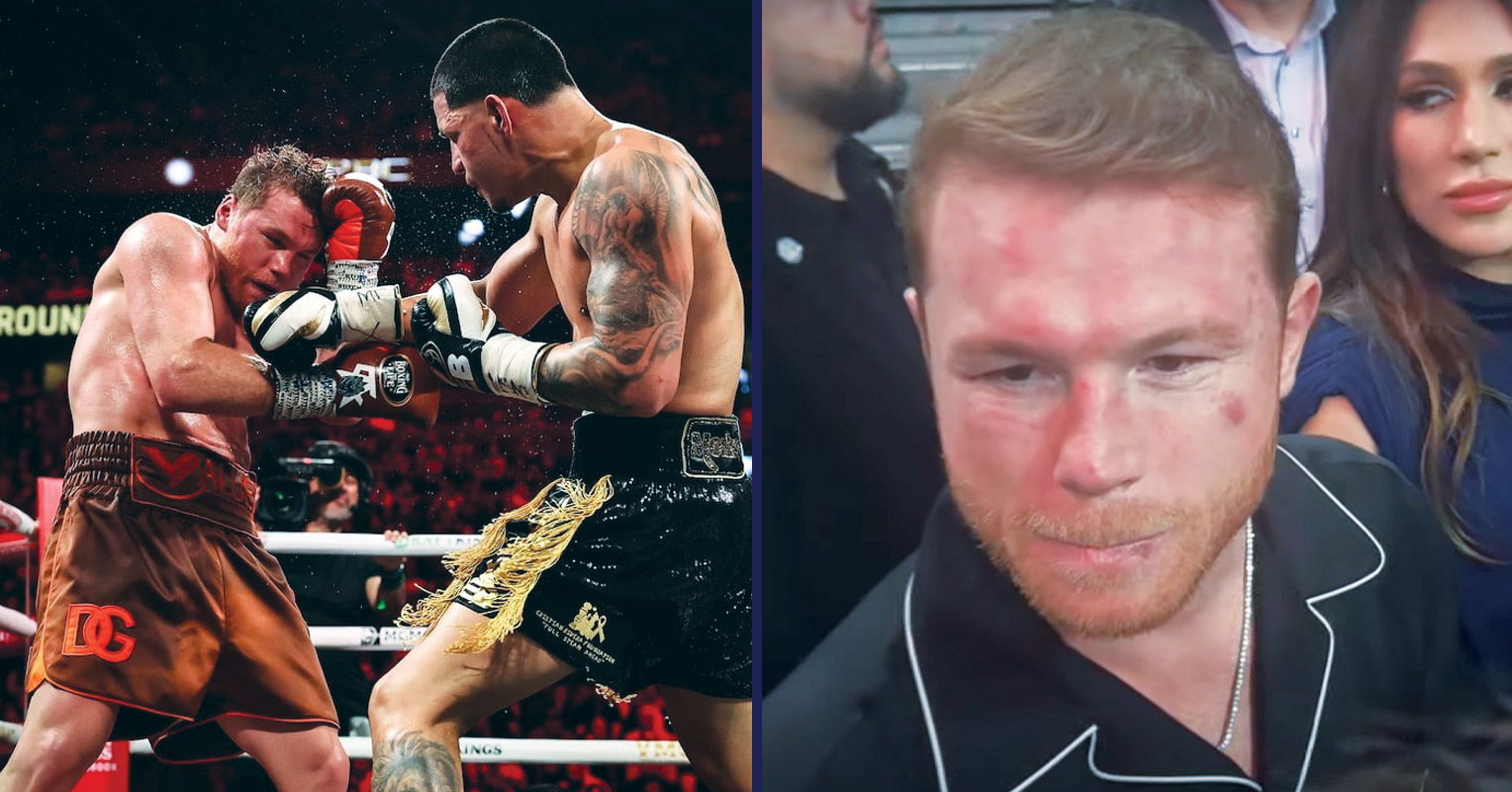 Canelo Gives Honest Verdict On Edgar Berlanga’s Power As Fans Shocked At Post Fight Bruising